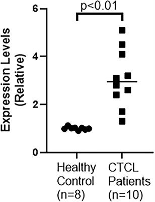 Epigenetic regulation of cutaneous T-cell lymphoma is mediated by dysregulated lncRNA MALAT1 through modulation of tumor microenvironment